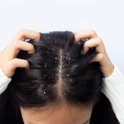 Parnik Naturals Anti-Dandruff Spray & Shampoo Combo | 2-Step Herbal Scalp Therapy for Flake-Free, Healthy Hair